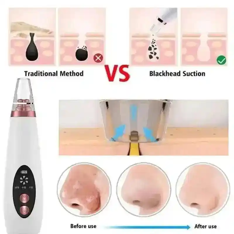blackhead remover